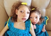 بالصور... شقيقتان تعانيان من مرض غريب بسبب إهمال والدتهما!