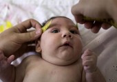 المكسيك تؤكد أول حالة إصابة بصغر الرأس الناجم عن فيروس زيكا